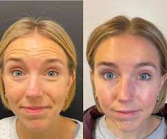 Botox before and after — forehead lines eliminated, female client with blue eyes